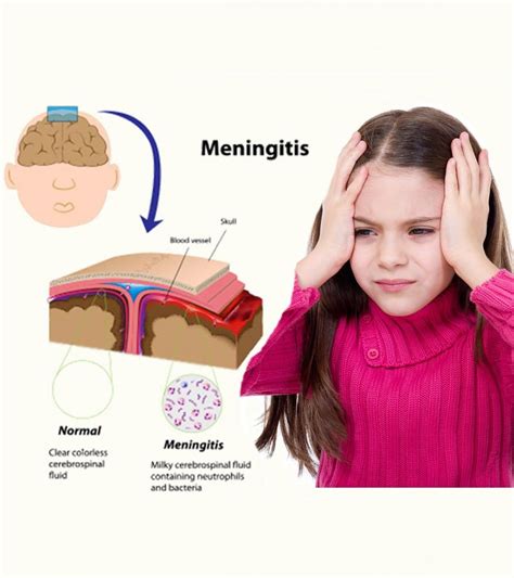 how to diagnose meningitis in children
